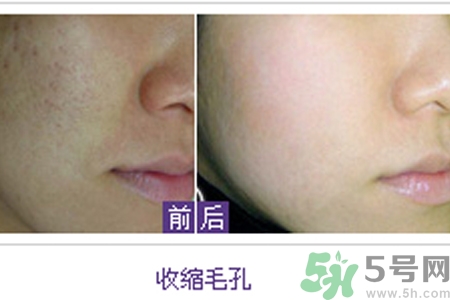 激光缩毛孔有风险吗,激光缩毛孔的危害和效果 激光缩毛孔有风险吗,激光缩毛孔的危害和效果