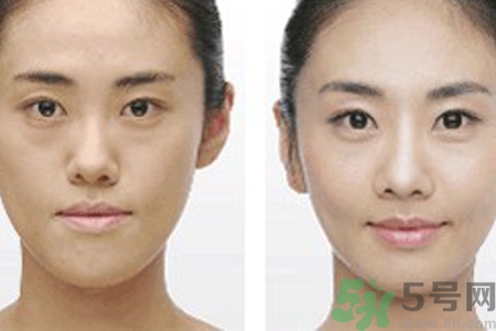 激光打毛孔要多少钱,激光毛孔收缩多少钱