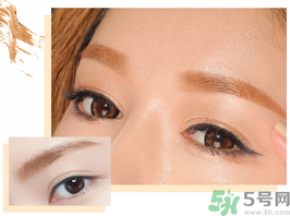 切眉后眼睛淤青怎么快速解决,切眉手术后眼睛淤青红肿严重怎么办