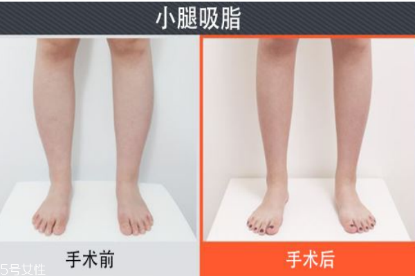 抽脂后多久可以运动健身,一般全身抽脂可以瘦掉多少 抽脂后多久可以运动健身,一般全身抽脂可以瘦掉多少