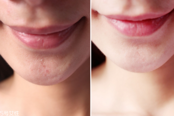 微针去痘印注意事项,微针去痘印吗