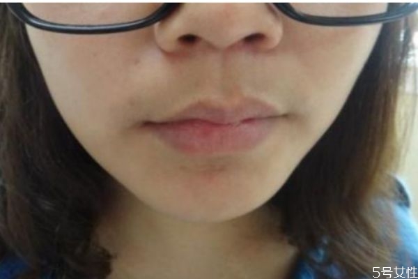 女孩唇上有毛是什么原因,女性唇毛旺盛是什么原因 女孩唇上有毛是什么原因,女性唇毛旺盛是什么原因