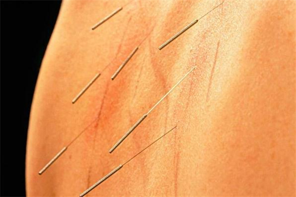 针灸减肥如何控制饮食,针灸减肥饮食注意事项 针灸减肥如何控制饮食,针灸减肥饮食注意事项
