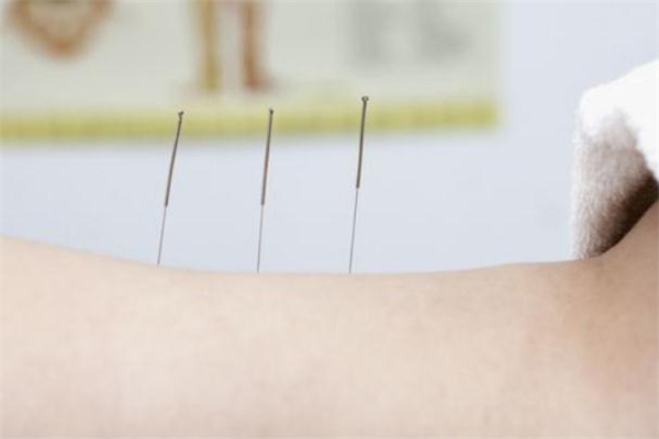 针灸减肥会不会影响怀孕,针灸真的能减肥吗