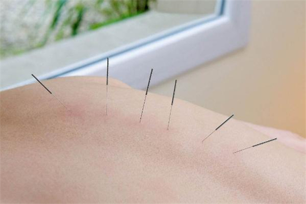 针灸减肥后能吃东西吗,针灸减肥不能吃的东西