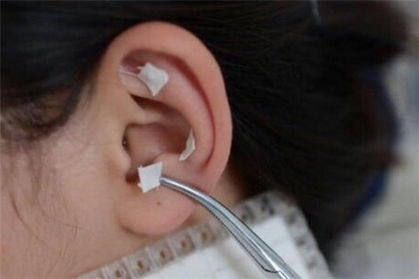 耳针贴有用吗,医生贴的耳针有什么作用 耳针贴有用吗,医生贴的耳针有什么作用