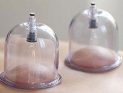 拔罐减肥拔哪些部位图,附近哪里有拔罐减肥的地方