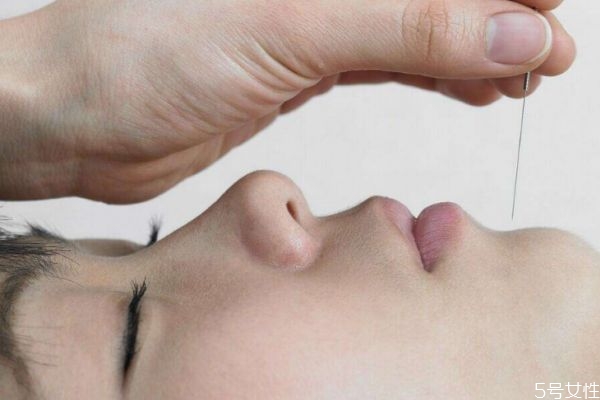 埋线减肥好吗,埋线减肥效果好不好