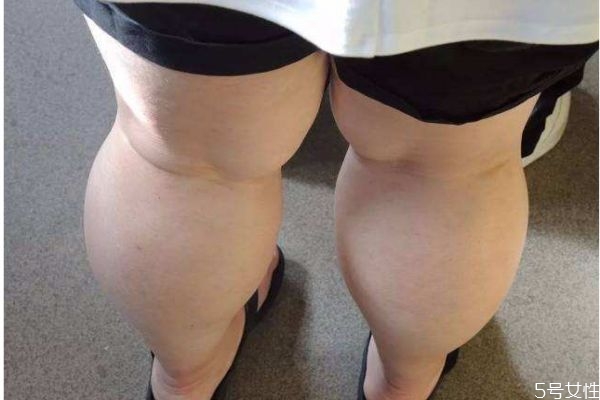 如何消除大象腿,怎么减掉大象腿