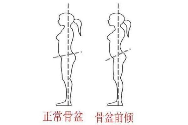 骨盆前倾自测方法,盆骨前倾怎么调整过来吗