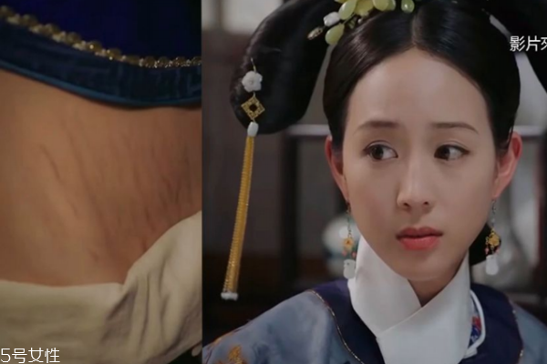 海兰的妊娠纹后来好了吗,海兰妊辰纹