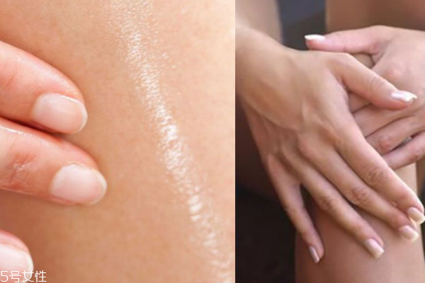 鱼鳞病是什么病严重吗,鱼鳞病是什么病?