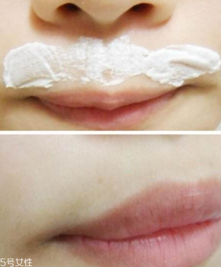 哪里可以去除唇毛,做唇毛好不好