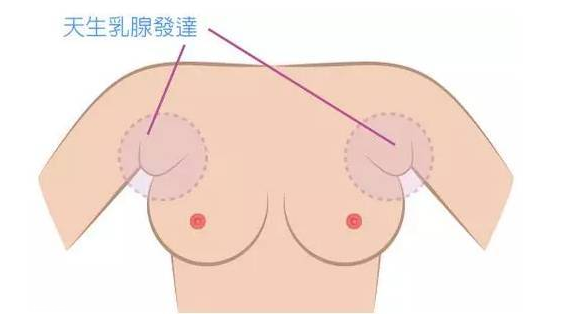 假副乳和真副乳的区别,真性副乳和假性副乳的区别
