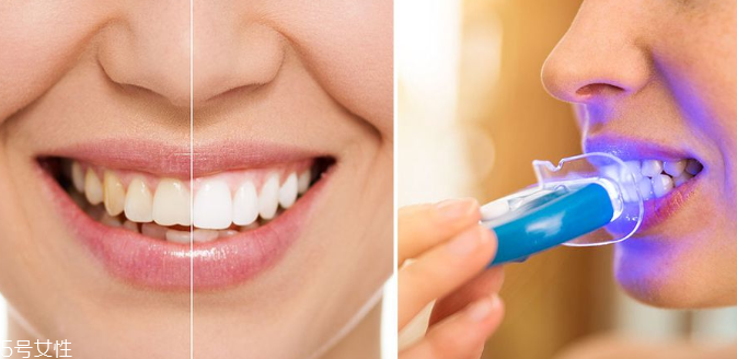 怎么美白牙齿最有效的方法,怎么样美白牙齿最快最有效