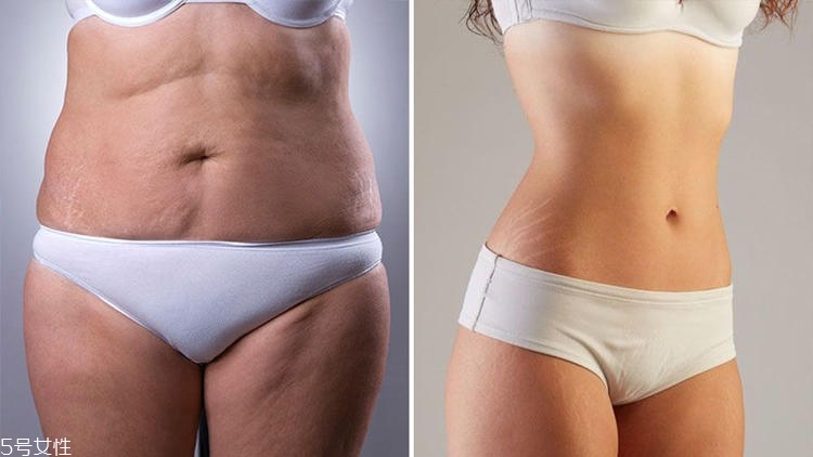 橘皮纹什么样子,橘样皮肤和橘皮纹一样吗 橘皮纹什么样子,橘样皮肤和橘皮纹一样吗