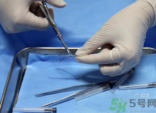 埋线减肥没效果,减肥埋线有效果吗