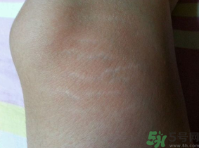 减肥能消除肥胖纹吗,瘦了肥胖纹会消失吗