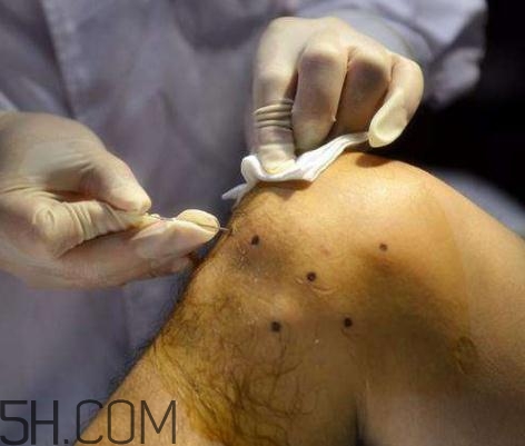 关节炎有积液怎么治疗,关节炎积水用什么药最好