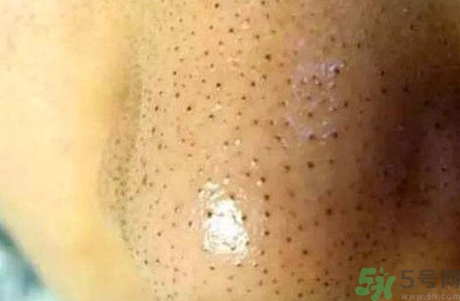 黑头白头粉刺可以挤(白头粉刺可以挤吗)