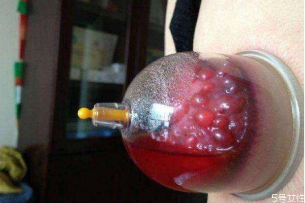 拔罐后出水泡怎么办(拔罐后出水泡怎么办?)
