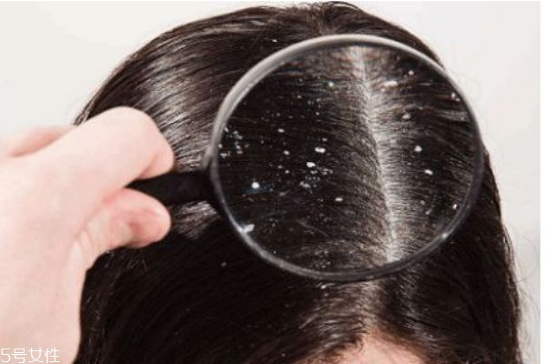 如何消除头皮屑呢(怎么消除头皮屑) 如何消除头皮屑呢(怎么消除头皮屑)