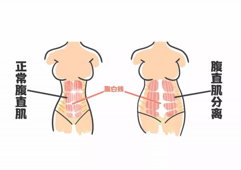 腹直肌拉伤怎么办(腹直肌拉伤怎么办) 腹直肌拉伤怎么办(腹直肌拉伤怎么办)