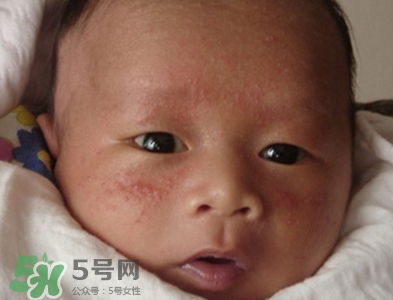 新生儿痤疮原因引起的,新生儿起痤疮是因为什么