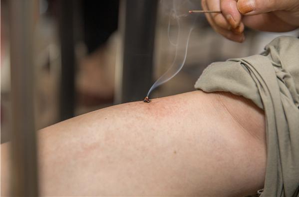 哪些人群不适合艾灸,艾灸适合所有人吗