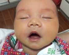 婴儿黄疸吃什么药退黄,新生儿退黄疸的药什么药最好 婴儿黄疸吃什么药退黄,新生儿退黄疸的药什么药最好