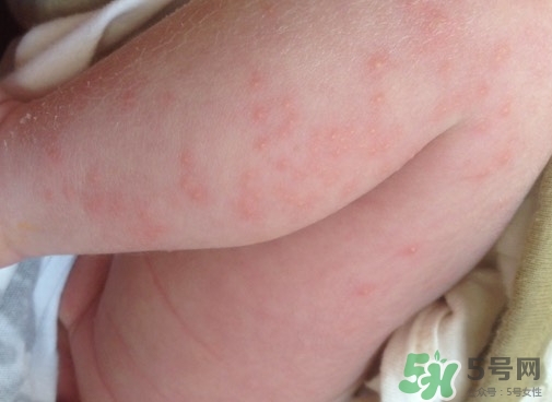 新生儿身上有红点是什么原因引起的,新生儿身上都是红点怎么回事