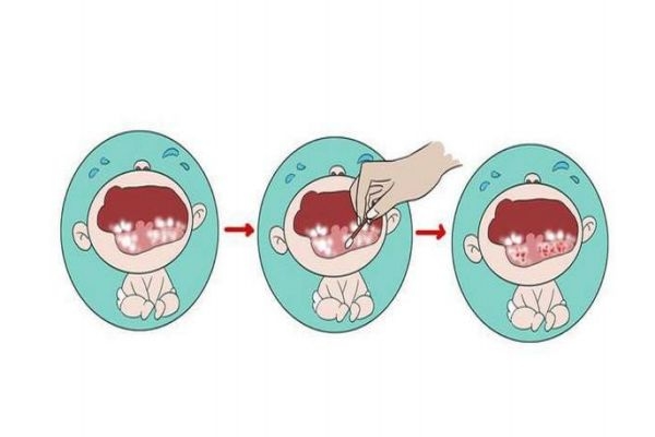 三岁宝宝嘴巴酸臭怎么回事,八个月宝宝嘴巴酸臭怎么回事