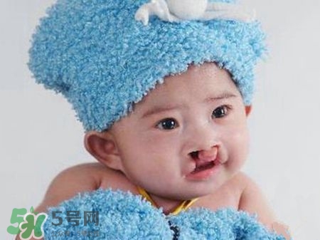 兔唇修复手术,兔唇修补术是不是免费