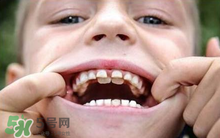小孩换牙齿需要吃钙片吗,儿童换牙吃什么钙片补钙效果好