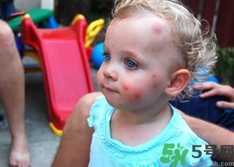 宝宝被蚊子咬了怎么消肿止痒最快,宝宝蚊虫叮咬消肿止痒 宝宝被蚊子咬了怎么消肿止痒最快,宝宝蚊虫叮咬消肿止痒