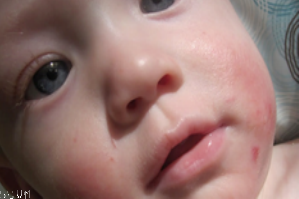 宝宝脸上长湿疹的原因有哪些,小孩脸长湿疹是什么原因 宝宝脸上长湿疹的原因有哪些,小孩脸长湿疹是什么原因