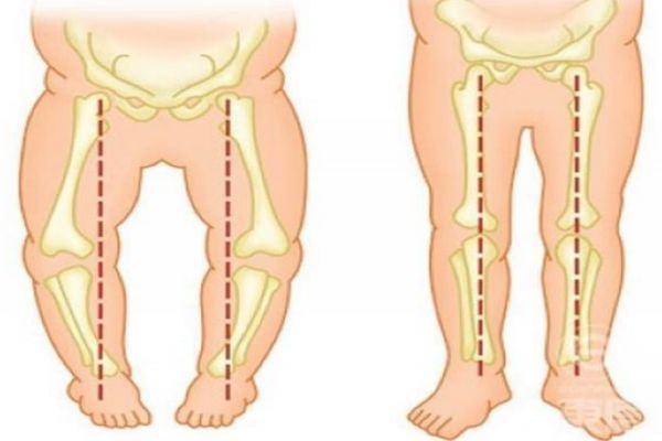 小孩子走路内八字怎么矫正,宝宝走路外八字怎么纠正