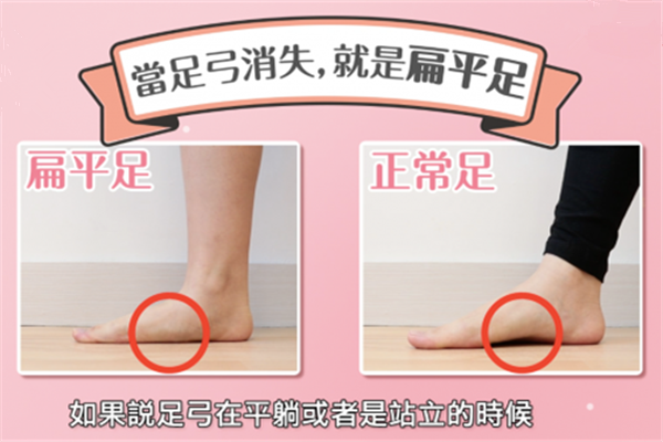 什么是扁平足图片,怎么分辨自己是不是扁平足 什么是扁平足图片,怎么分辨自己是不是扁平足