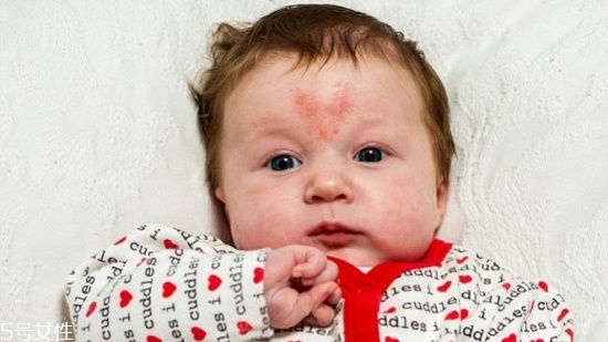 哪种胎记会自行消退,什么颜色的胎记会退掉