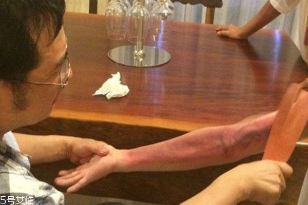 拍痧有科学依据吗,拍痧到底有用吗