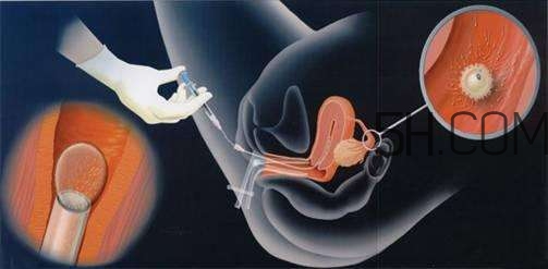 卵子怎么取出来过程,人工取卵子的操作过程