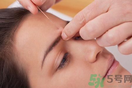 面瘫针灸一次要扎多长时间,针灸一次一般扎多长时间