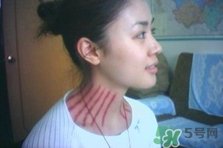 最疼的揪痧怎么揪,揪痧是什么意思