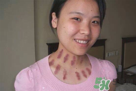 揪痧和刮痧的作用有什么区别,拔罐和刮痧哪个效果好