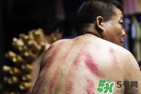 刮痧后拔火罐正确吗,刮痧后背部疼痛 刮痧后拔火罐正确吗,刮痧后背部疼痛