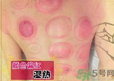 拔罐后的罐印的颜色是什么问题,拔罐颜色越深说明什么