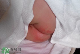 小宝宝尿布疹可以擦些什么药,小孩屁股尿布疹怎么办要擦什么药