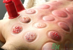 拔火罐可以去除体内的湿气吗,拔火罐能去湿气吗身上湿气重怎么办 拔火罐可以去除体内的湿气吗,拔火罐能去湿气吗身上湿气重怎么办