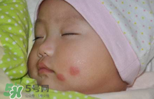 婴儿蚊子咬了红点怎么消除,被蚊子叮咬起红点要怎么消除呢?