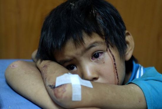 儿童跌落伤如何预防,儿童摔伤怎么处理